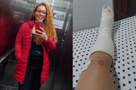 Rio de Janeiro (RJ), 31/07/2025 - Erika Rogatti mostra ferimentos e pé engessado após acidente com moto. Foto: Erika Rogatti/Arquivo Pessoal